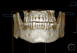 Sicurezza in implantologia e in odontoiatria generale