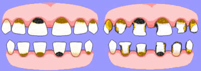 COS' E' LA CARIE DA BIBERON? - Centro Face dr.ssa Barina srl