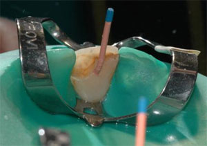 Il successo e l'insuccesso in endodonzia: come, quando, perche'