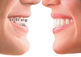 Ortodonzia Invisibile è Ortodonzia Estetica: il trattamento è nascosto alla vista