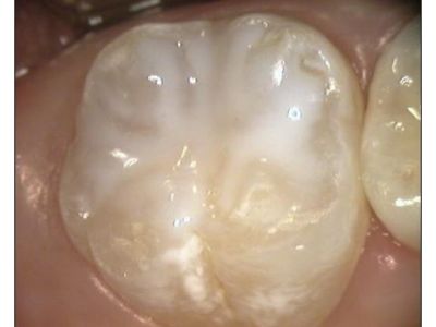 Solchi protetti dalle Sigillature dentali
