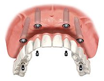 Dalla dentiera alla protesi fissa
