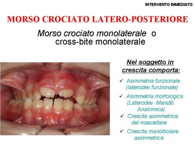 Intercettamento immediato
