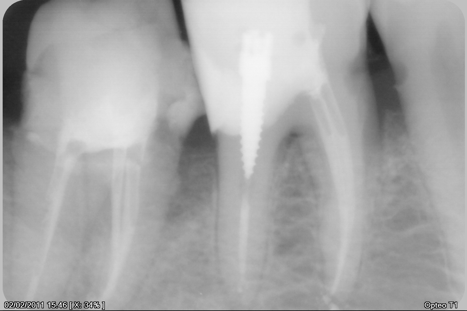 Endodonzia in soli tre strumenti