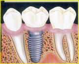 Cosa sono gli impianti dentali?