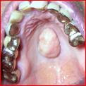 Classificazione delle neoplasie o tumori delle parti molli del cavo orale