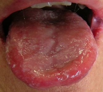 Stomatite da candida