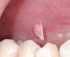 papilloma peduncolato lingua