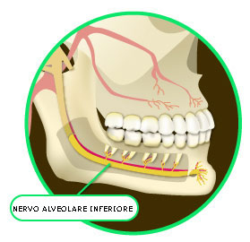 Le lesioni del Nervo Alveolare Inferiore (NAI) nella pratica Odontoiatrica