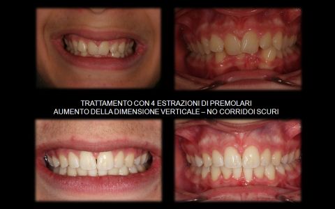 Caso con estrazioni 2 premolari superiori (4-ti) e 2 inferiori (5-ti)
