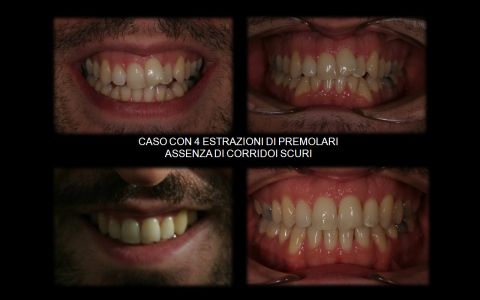 Caso con estrazione di 2 premolari superiori (5-ti) e 2 inferiori (4-ti)