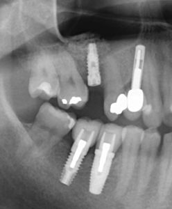 Controllo radiografico post-operatorio.