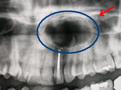 Cisti odontogene infiammatorie