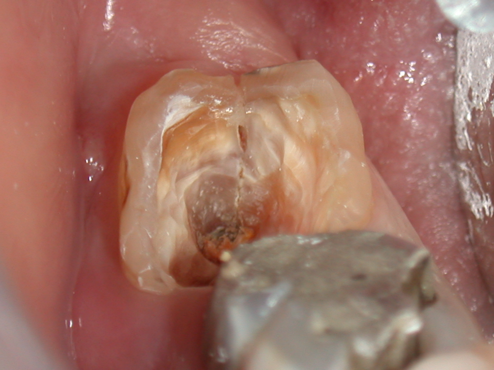 L'importanza di ricoprire i denti devitalizzati
