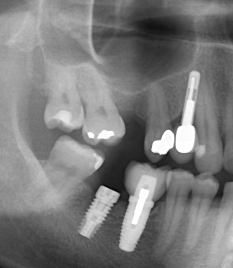 Implantologia: il rialzo di seno mascellare.