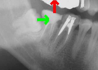 Denti del giudizio: validi sostituti dei denti persi - Autotrapianto (tooth autotransplantation or autogenous tooth transplantation)