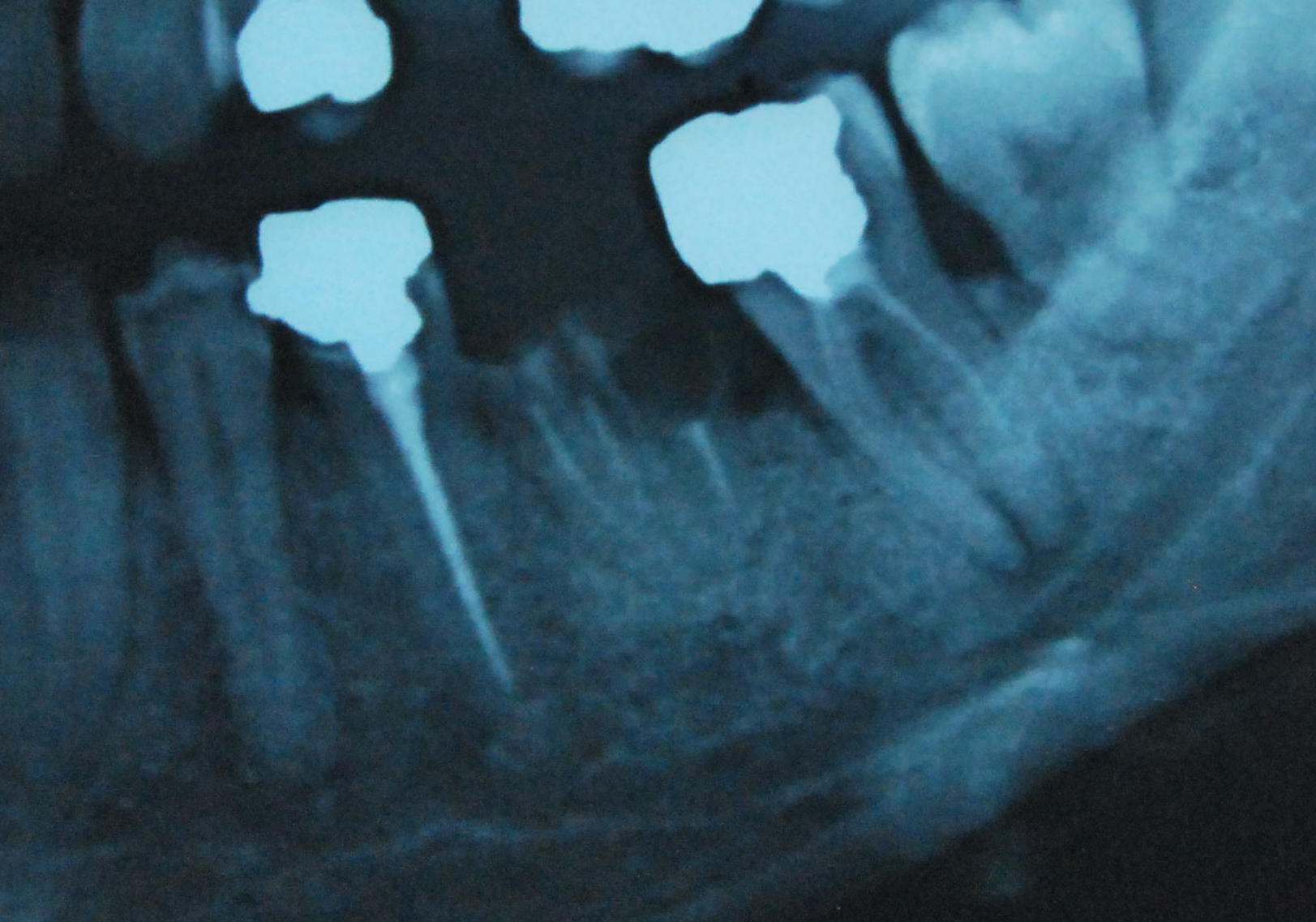 Trattamento lesioni di origine endodontica