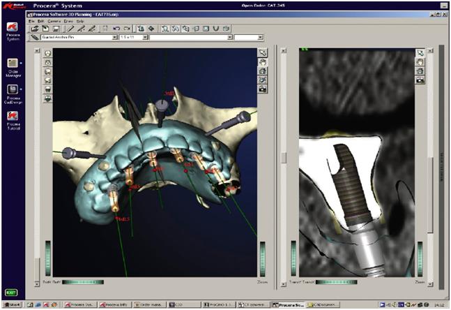 Implantologia guidata dal computer: realta', non fantascienza