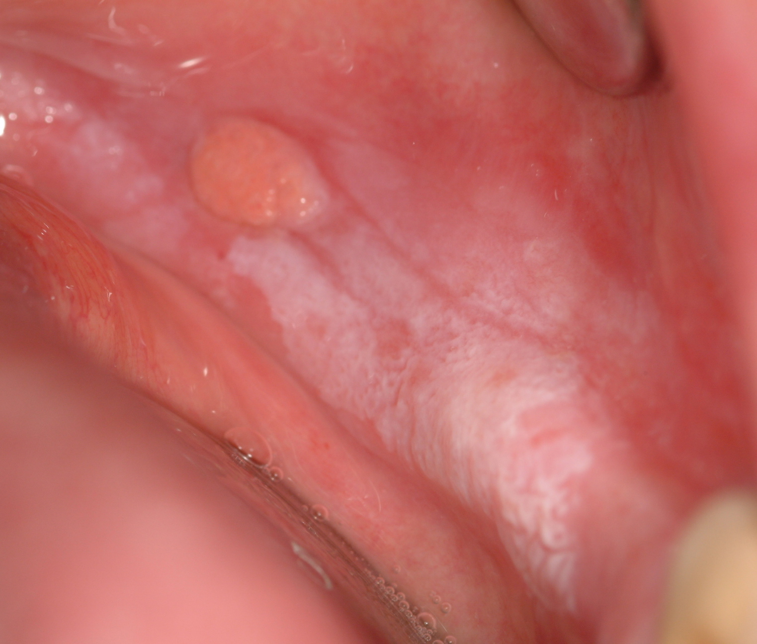 Cancro Orale