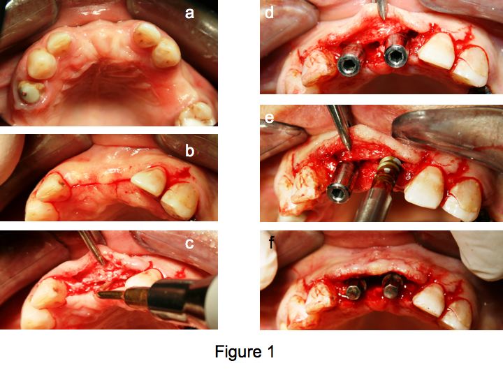 Split crest e sinus lift associati a carico immediato implantare in un unico tempo chirurgico. 16 casi sperimentali consecutivi