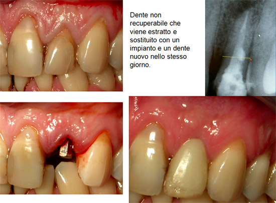 Immediate placement and temporization of implants: 3- to 5-year retrospective results.