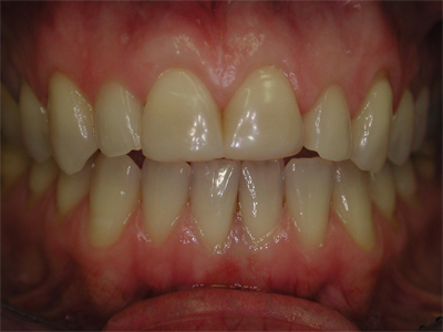 Sostituzione di vecchie otturazioni frontali discromiche con faccette estetiche in ceramica