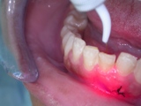 laser ed endodonzia