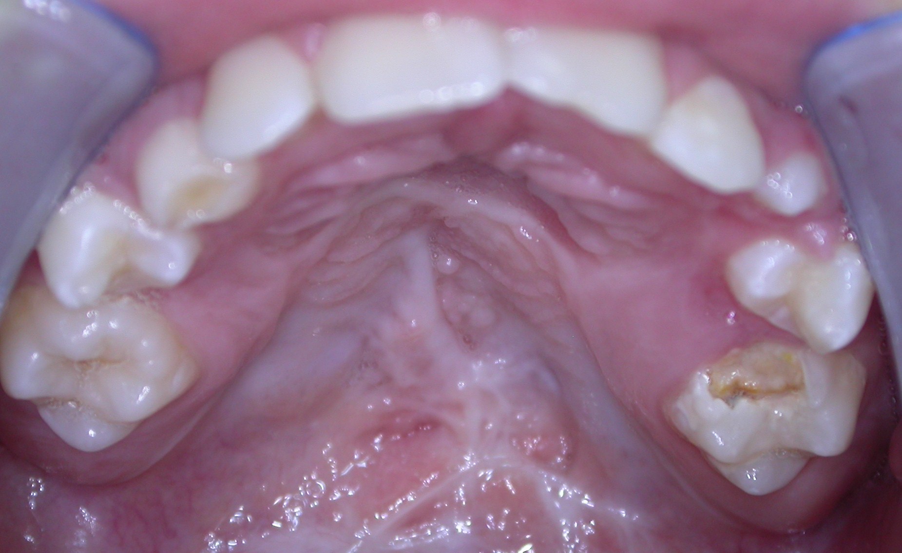 L'endodonzia dei denti decidui
