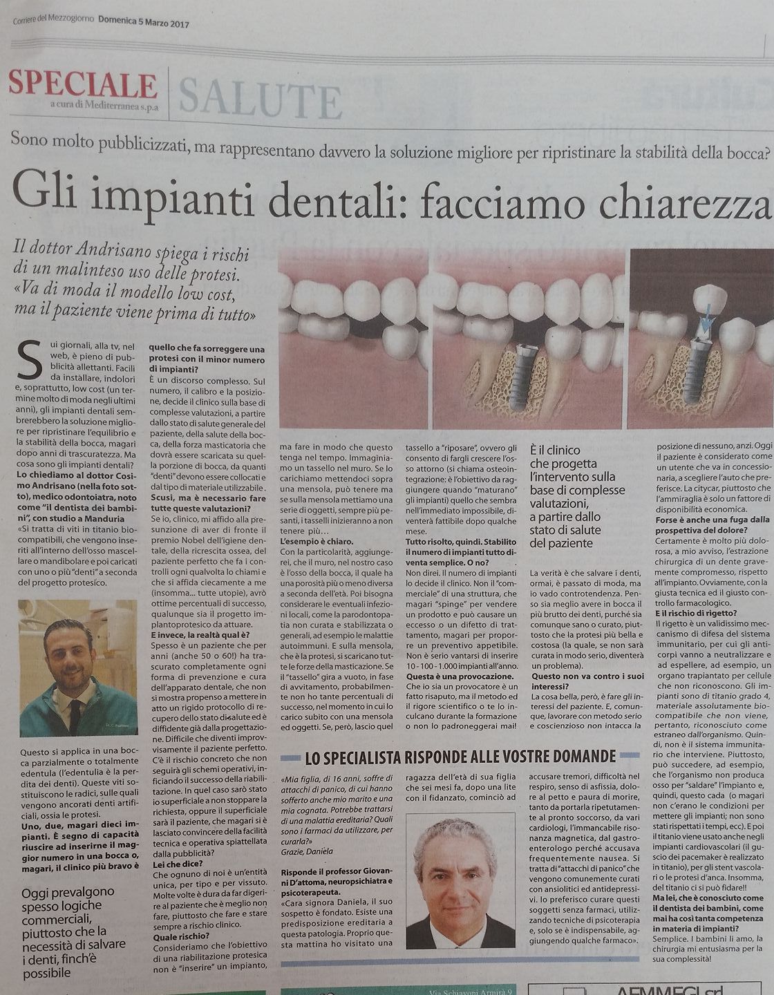 Gli impianti dentali: facciamo chiarezza