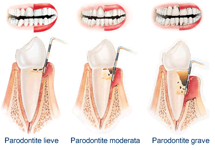 Genetica e Malattia Parodontale