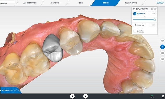La Rivoluzione dell'Impronta Digitale Dentale con Tecnologia CAD-CAM