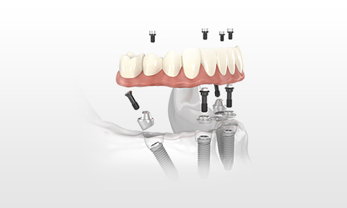 Riabilitazione totale a carico immediato con Impianti dentali: il Protocollo 'All on 4'