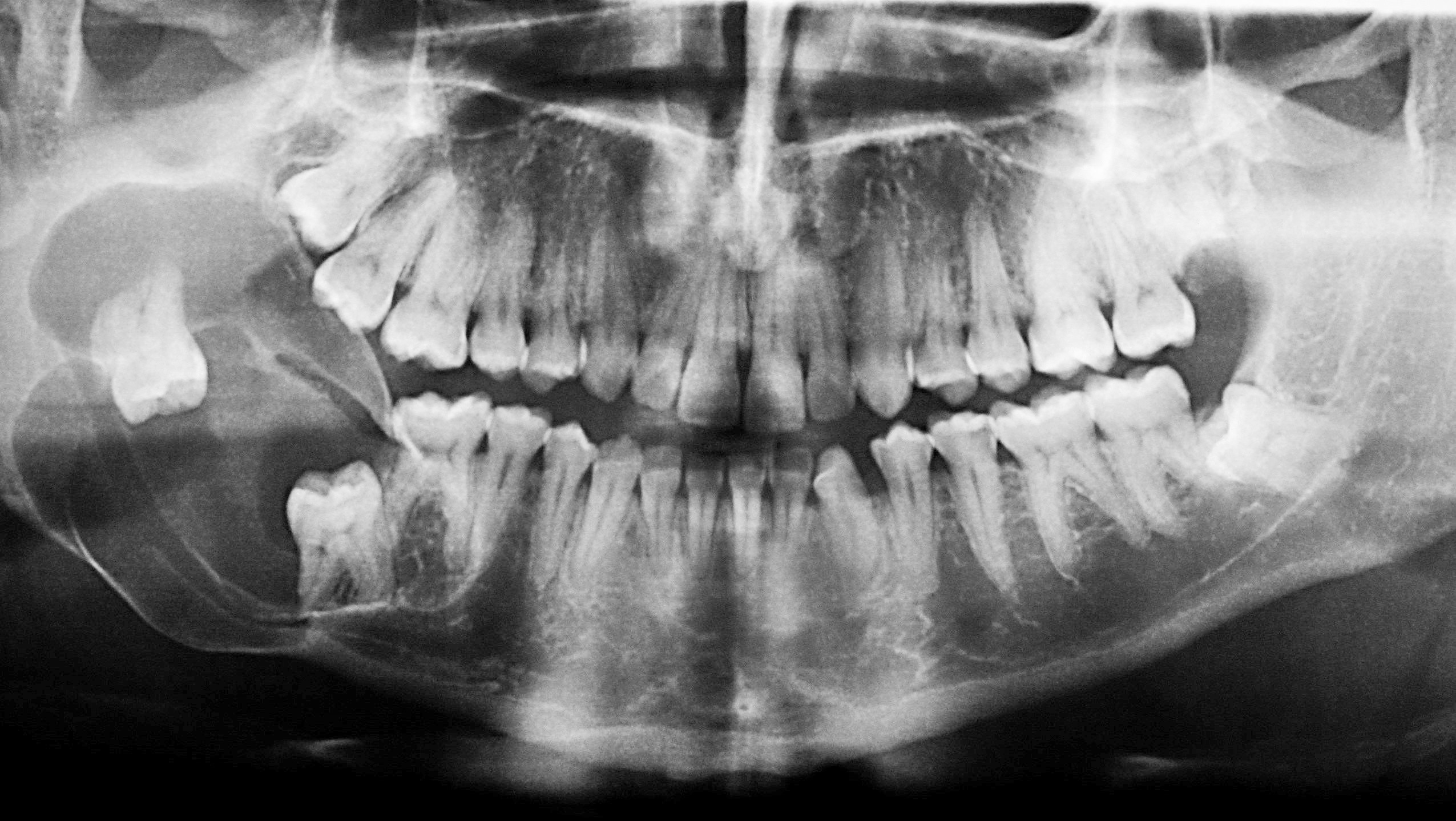 L'Ameloblastoma