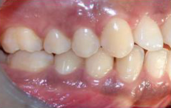 Vantaggi nell'utilizzo delle fibre di vetro in ortodonzia