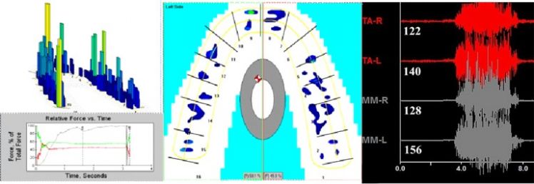 Analisi T-scan e EMG su ortotico