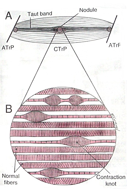 Cefalee tensive e disordini cranio-mandibolari