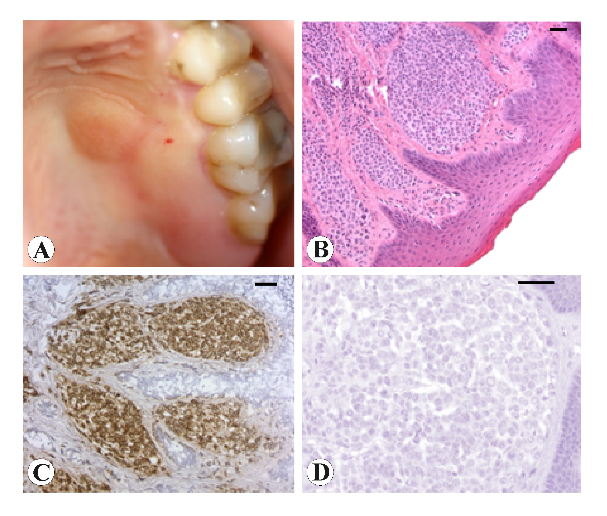 Non pigmented melanocytic nevus of the oral cavity. A case report