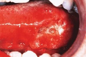 Carcinoma lingua