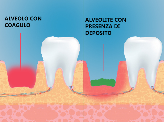 Alveolite post estrattiva