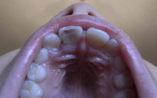Fratture dentali - fratture radicolari