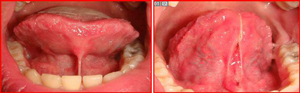 Frenulectomia linguale con laser a diodi