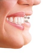 Invisalign: riprendiamoci il sorriso