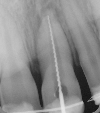 Traumi dentali: come comportarsi