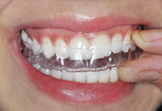 Apparecchio invisibile - mascherine trasparenti per raddrizzare i denti