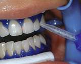 Lo Sbiancamento Dentale Professionale