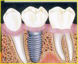estrazione dente - conseguenze osso