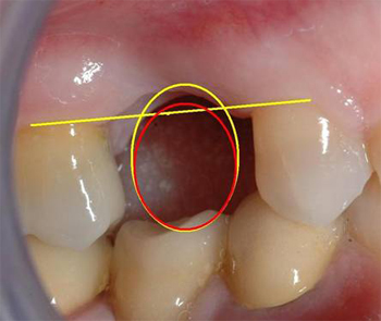 in giallo la forma ovale del dente che emergera’ dalla gengiva, in rosso si può vedere la sua forma ideale