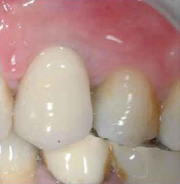 risultato finale - dente più lungo del dente naturale adiacente