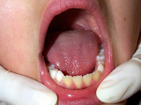 Macroglossia