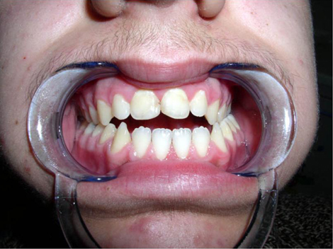 Macroglossia, deglutizione atipica e respirazione orale non curate